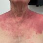 ep 10. Photosensitivity