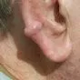 ep 9. JT - consented - keloid scar (use this one instead)