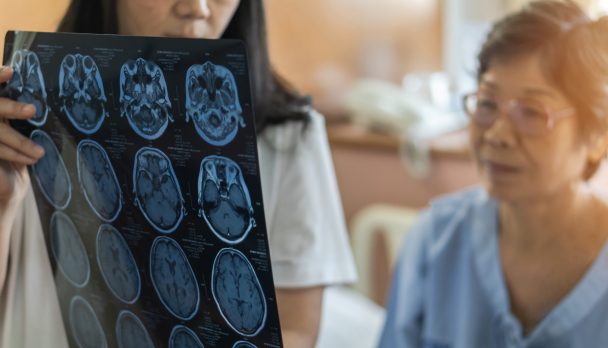 Brain disease diagnosis with medical doctor diagnosing elderly ageing patient neurodegenerative illness problem seeing Magnetic Resonance Imaging (MRI) film for neurological medical treatment